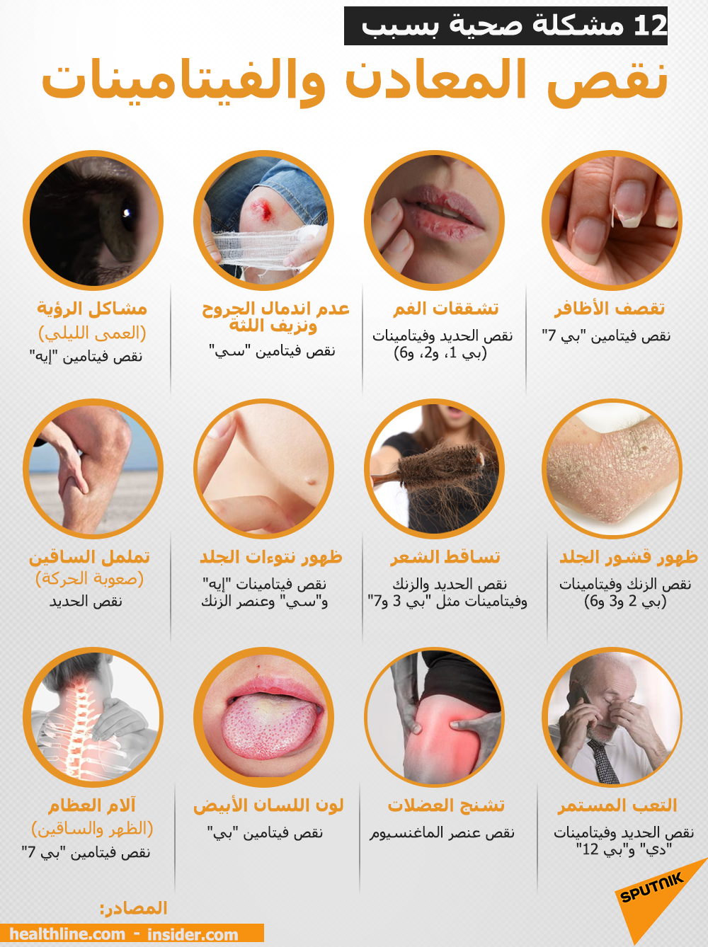 12 مشكلة صحية بسبب نقص المعادن والفيتامينات - سبوتنيك عربي