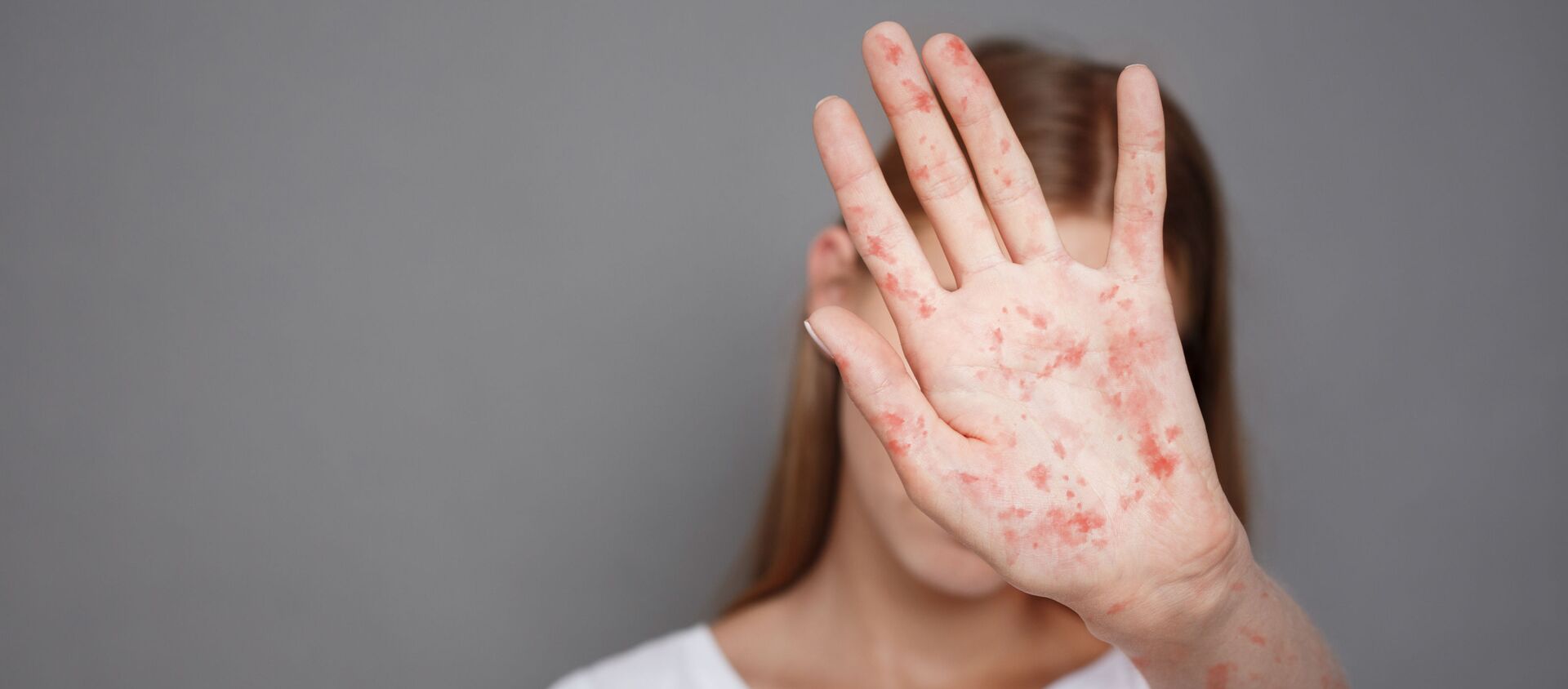 فتاة تعاني من حساسية جلدية - سبوتنيك عربي, 1920, 09.09.2020