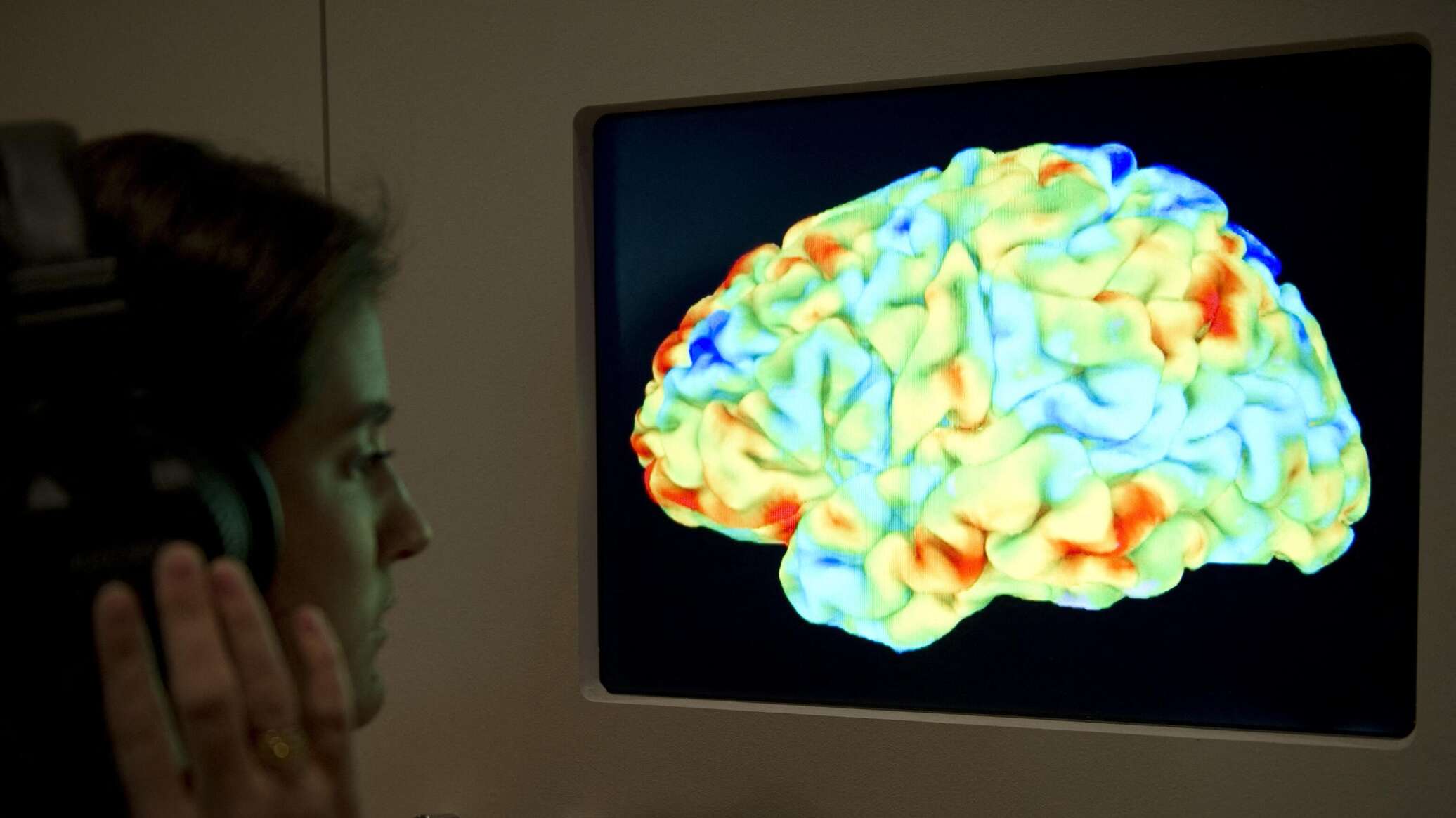 أول مريض يخضع لزرع شريحة دماغ تابعة لإيلون ماسك يكشف لـ"سبوتنيك" التغيرات التي طرأت عليه