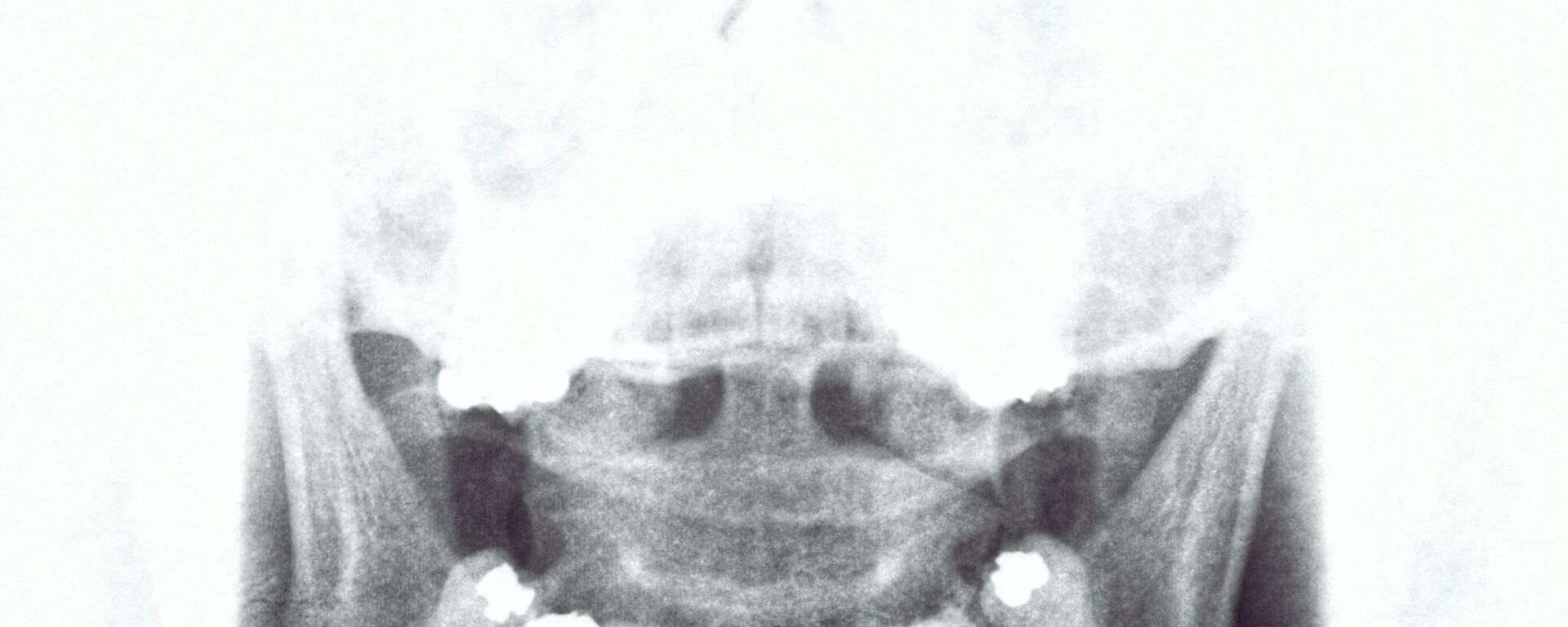 صورة شعاعية لجمجمة إنسان  - سبوتنيك عربي, 1920, 25.08.2025