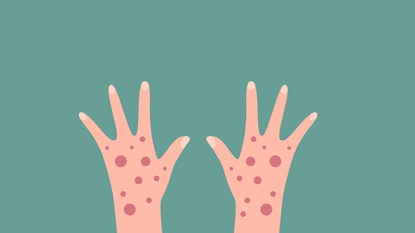 مواقع انتشار جدري القرود في دول العالم - سبوتنيك عربي