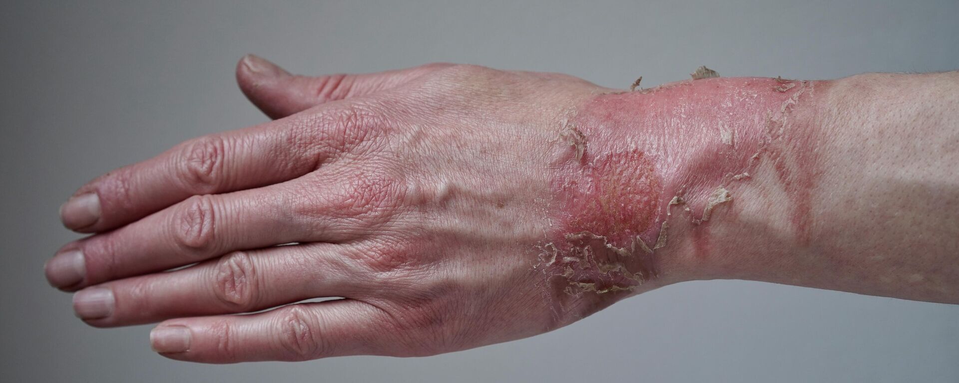 لقطة مقربة ليد امرأة مصابة ببثرة منفجرة من حرق بالماء المغلي  - سبوتنيك عربي, 1920, 11.11.2024