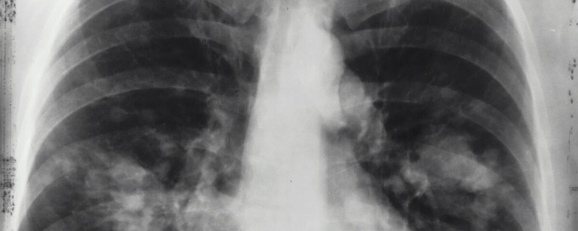 أشعة للرئة - سبوتنيك عربي, 1920, 15.02.2025