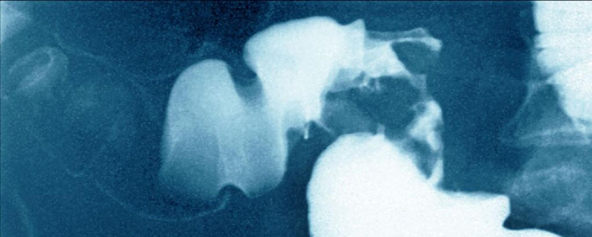 سرطان القولون - سبوتنيك عربي, 1920, 22.02.2025