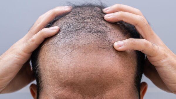 رجل أصلع - سبوتنيك عربي