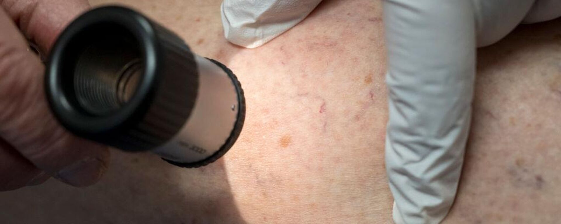 سرطان الجلد - سبوتنيك عربي, 1920, 03.06.2025