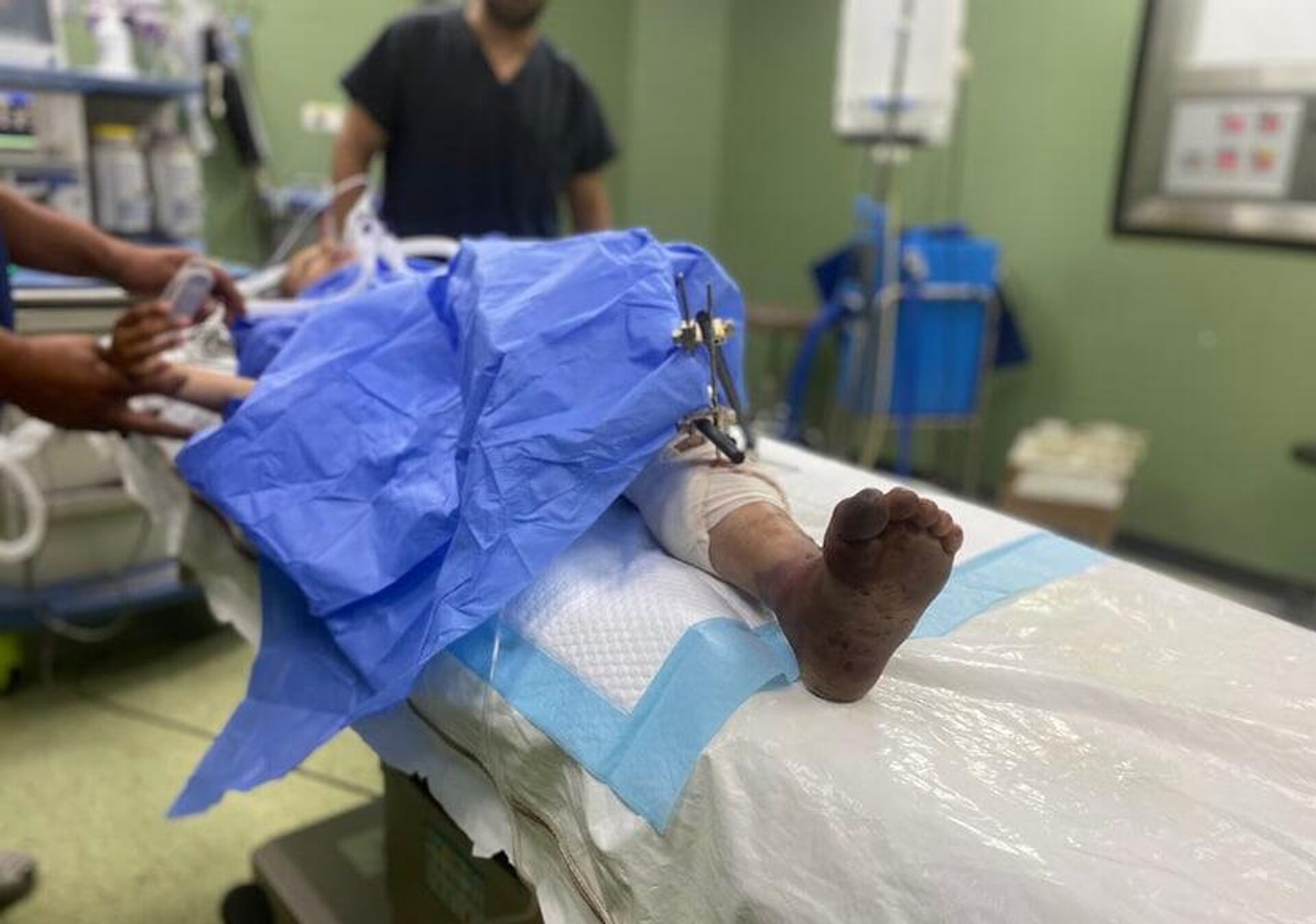 الطفلة سيلا تفقد ساقيها وتحلم بالمشي مجددا   - سبوتنيك عربي, 1920, 26.06.2025