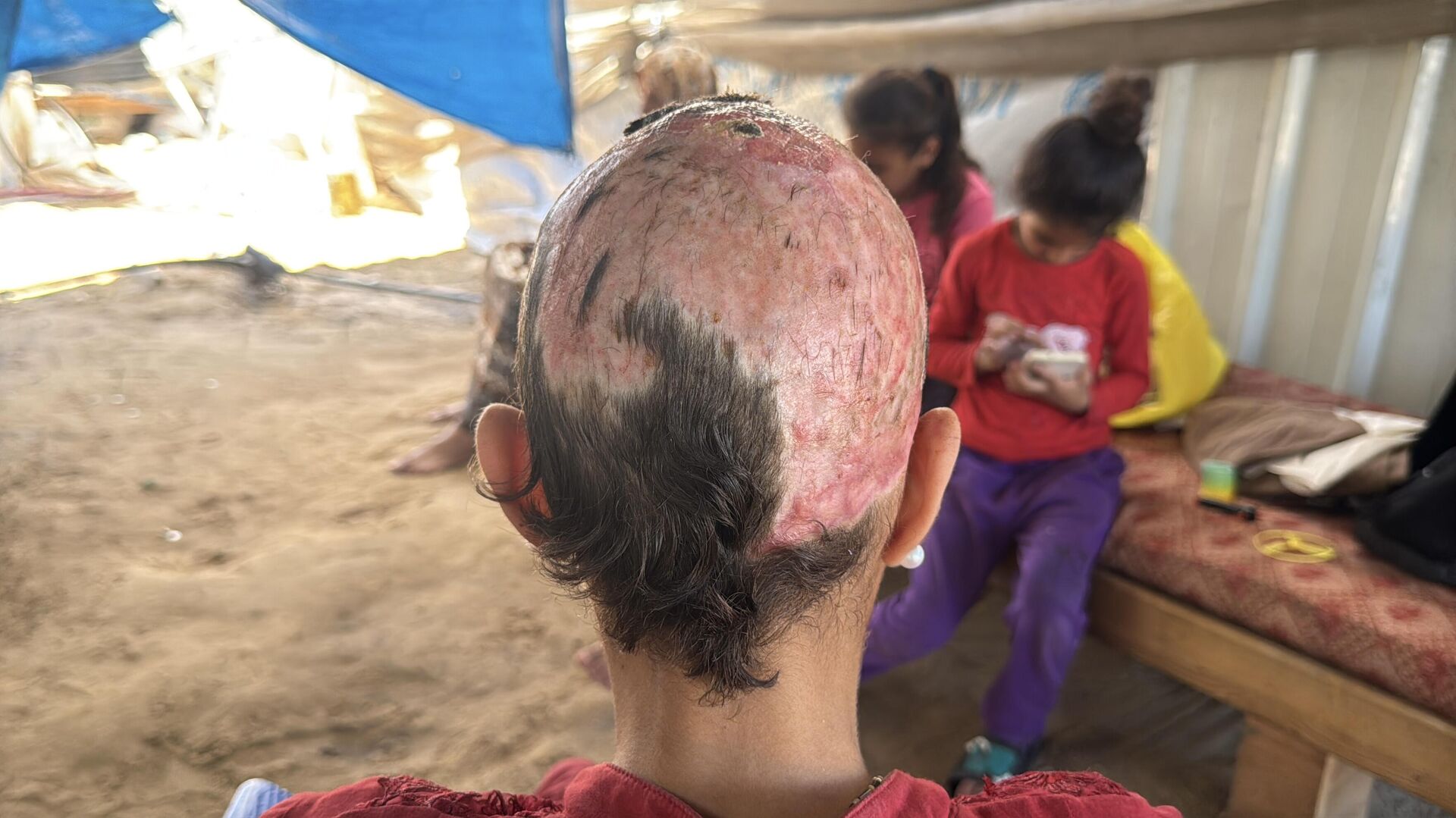 طفلة فلسطينية تحلم بعودة شعرها الذي أحرقته قذائف الحرب  - سبوتنيك عربي, 1920, 10.07.2025