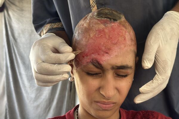 طفلة فلسطينية تحلم بعودة شعرها الذي أحرقته قذائف الحرب  - سبوتنيك عربي