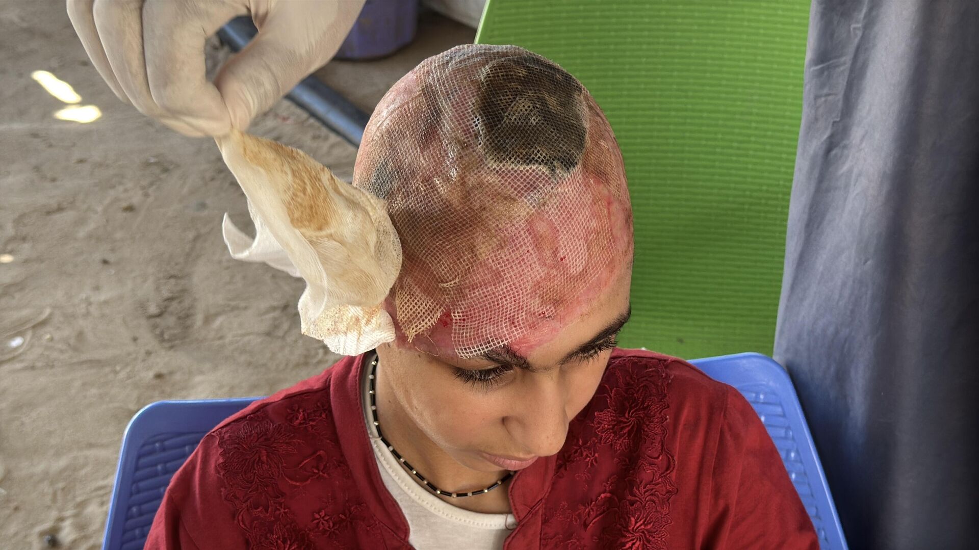 طفلة فلسطينية تحلم بعودة شعرها الذي أحرقته قذائف الحرب  - سبوتنيك عربي, 1920, 10.07.2025