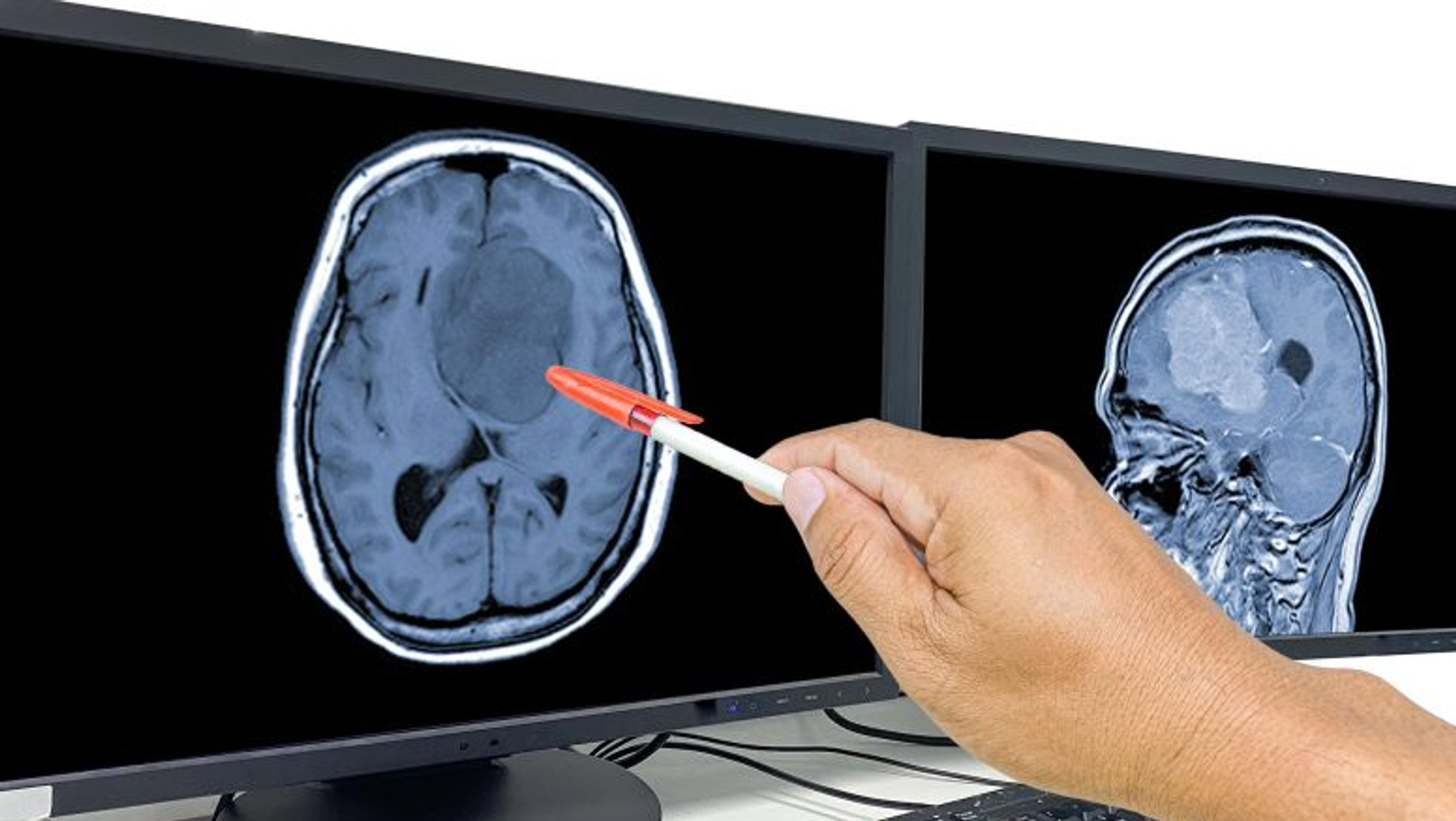 دراسة: دواء شائع يمكنه محاربة أحد أخطر أنواع سرطان المخ