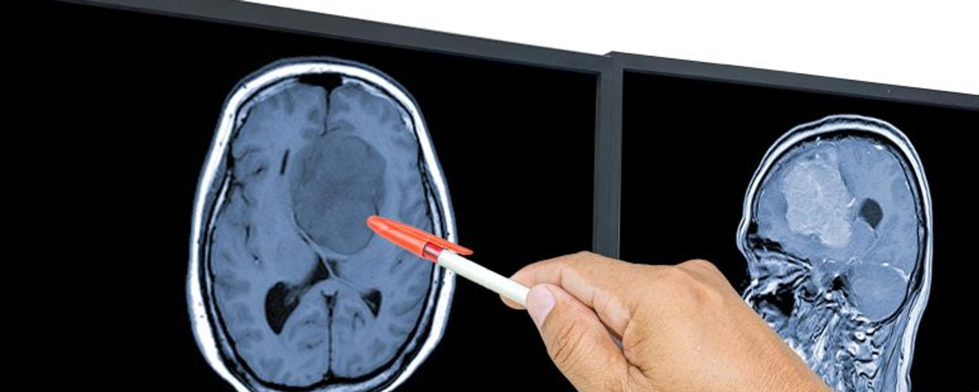 سرطان الدماغ - سبوتنيك عربي, 1920, 28.11.2025