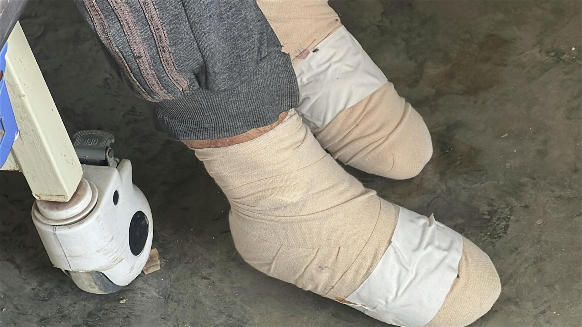 مصعب أبو طعيمة يتآكل جسده ببطء في انتظار أمل للعلاج خارج غزة  - سبوتنيك عربي, 1920, 30.04.2026