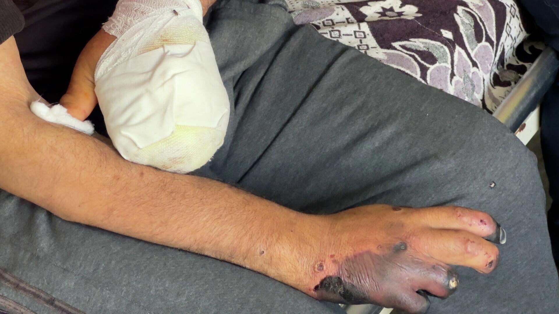 مصعب أبو طعيمة يتآكل جسده ببطء في انتظار أمل للعلاج خارج غزة  - سبوتنيك عربي, 1920, 30.04.2026