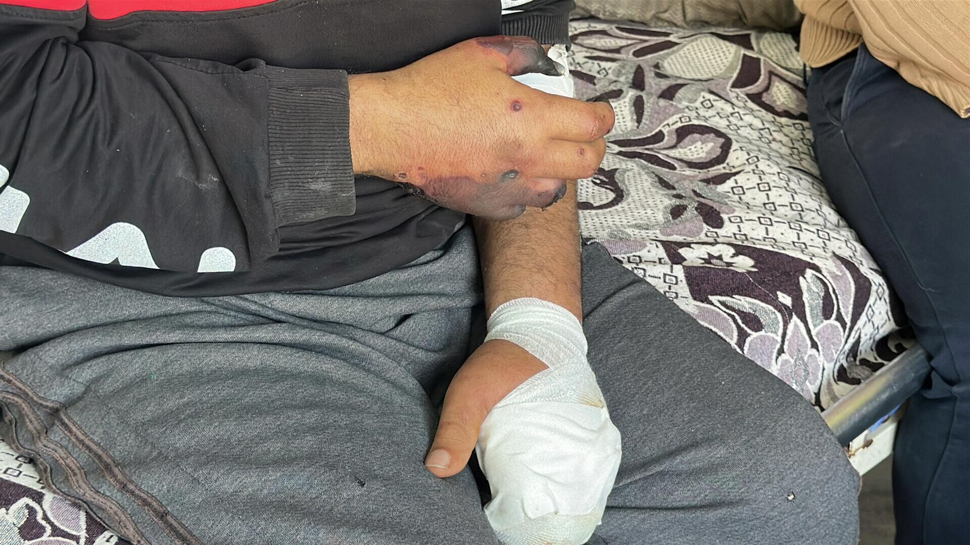 مصعب أبو طعيمة يتآكل جسده ببطء في انتظار أمل للعلاج خارج غزة  - سبوتنيك عربي, 1920, 30.04.2026