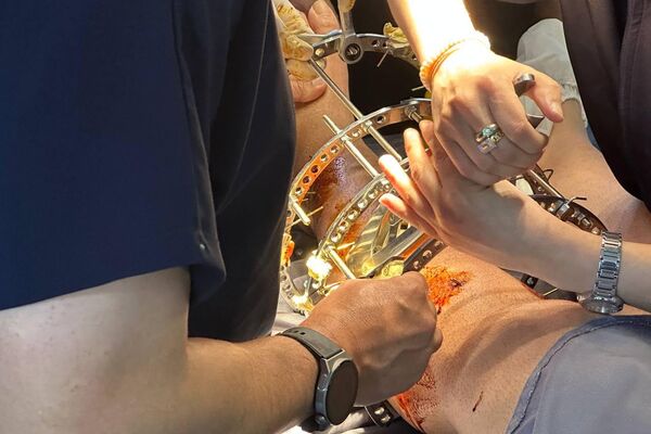 تقنية &quot;إليزاروف&quot; الروسية تدخل بقوة إلى الجزائر… أمل جديد لمرضى الكسور المعقدة وتشوهات العظام. - سبوتنيك عربي