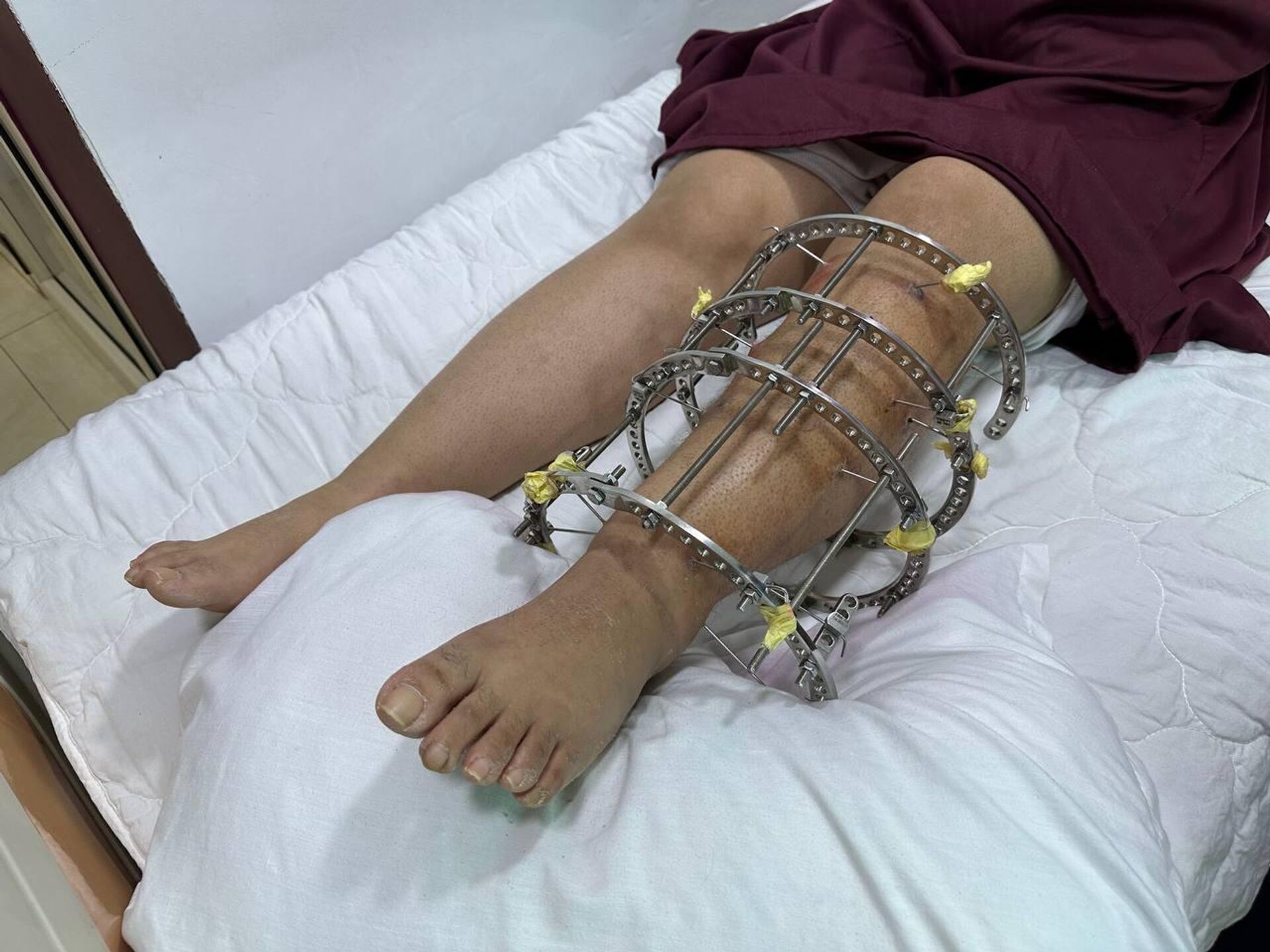 تقنية اليزاروف الروسية تدخل بقوة إلى الجزائر… أمل جديد لمرضى الكسور المعقدة وتشوهات العظام
 - سبوتنيك عربي, 1920, 30.04.2026