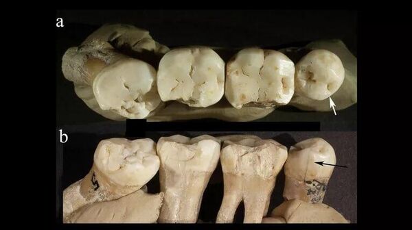 © Источник: David W. Frayer et al. Prehistoric dentistry? P4 rotation, partial M3 impaction, toothpick grooves and other signs of manipulation in Krapina Dental Person 20. Bulletin of the International association for paleodontology, Vol. 11 No. 1, 2017 - سبوتنيك عربي