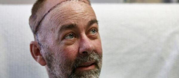 عملية لزراعة جمجمة - سبوتنيك عربي