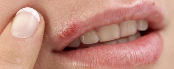 تقرحات الفم  - سبوتنيك عربي