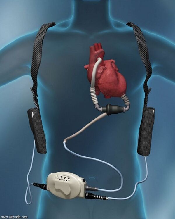 بقي على قيد الحياة 17 شهراً من دون قلب - سبوتنيك عربي