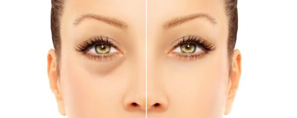 انتفاخ العينين - سبوتنيك عربي