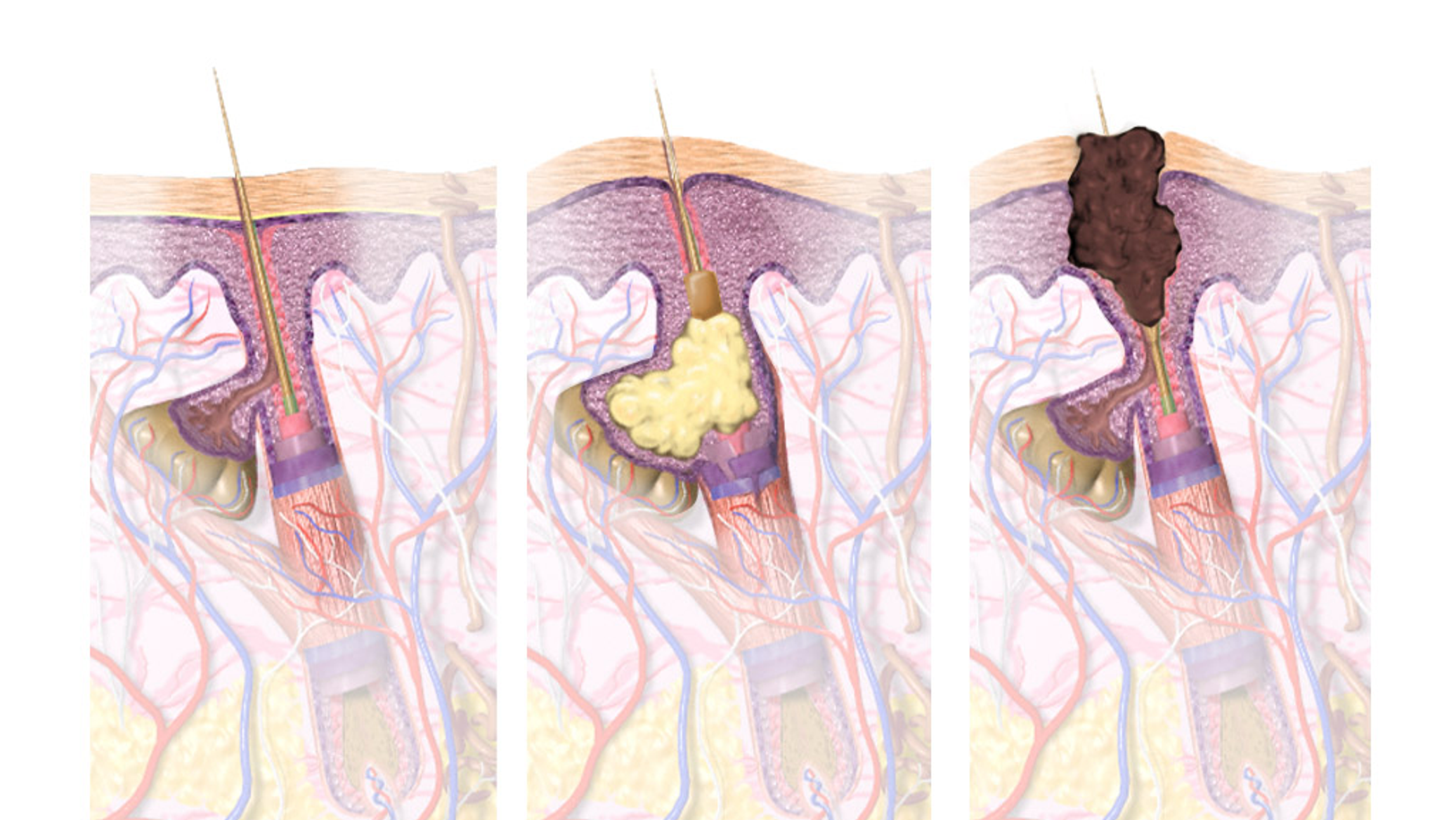 أطباء روس يكتشفون طريقة لتحسين علاج حب الشباب