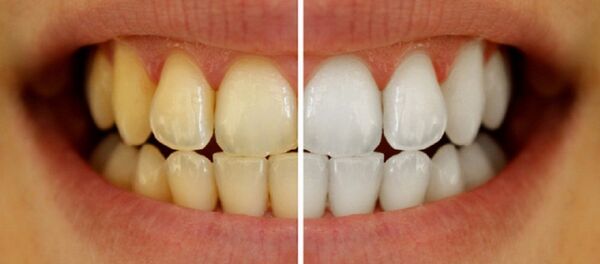 تبييض الأسنان - سبوتنيك عربي