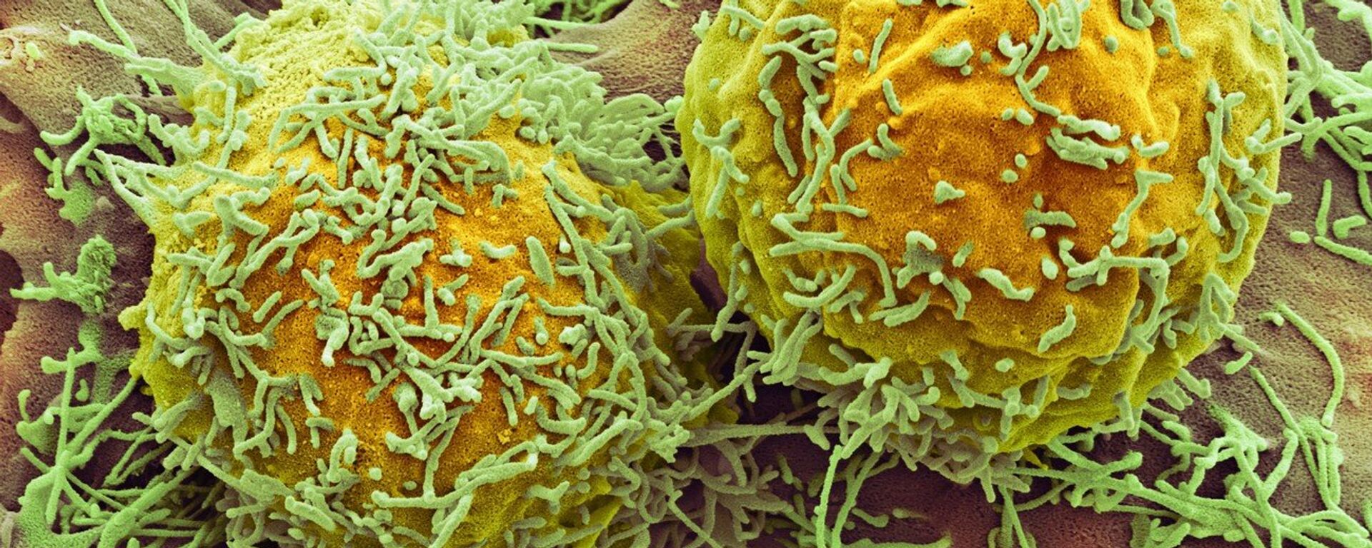 خلايا سرطانية - سبوتنيك عربي, 1920, 12.03.2025