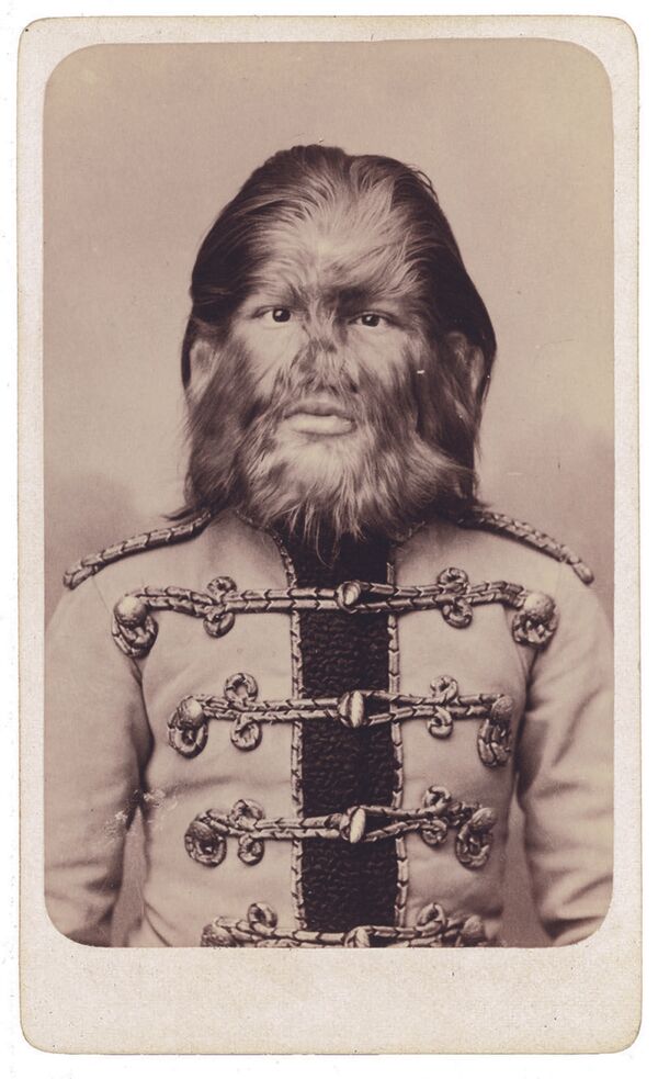 متلازمة فرط الشعر أو متلاذمة المستذئبين - سبوتنيك عربي