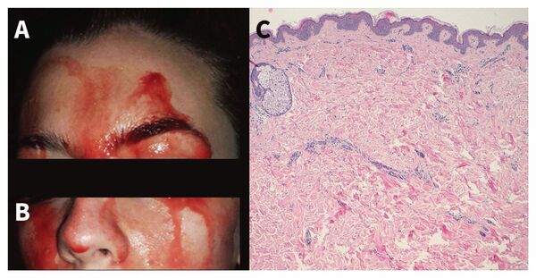 فتاة مصابة بمرض هيماتيدروسيس - سبوتنيك عربي