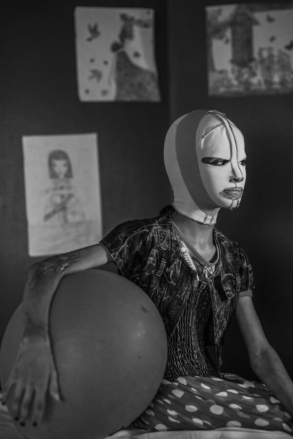 مسابقة صور الصحافة العالمية لعام 2018 - صورة بعنوان صور الحرب، منال للمصور أليسيو مامو، في فئة التصوير أشخاص منال (11 عاما) ضحية سقوط قذيفة صاروخية في كركوك بالعراق. وهي ترتدي قناعا لعدة ساعات في اليوم لحماية وجهها، بعد أن أجرت عملية تجميل دقيقة لوجهها في مستشفى المواساة في عمان بالأردن - سبوتنيك عربي