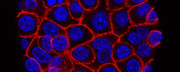 خلايا سرطانية - السرطان - سبوتنيك عربي