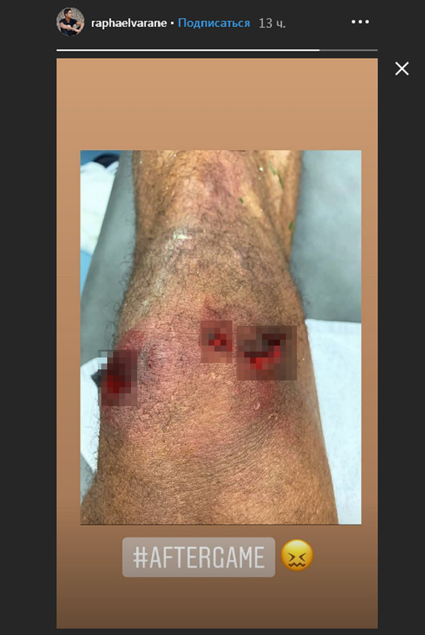 اصابة فاران لاعب ريال مدريد - سبوتنيك عربي