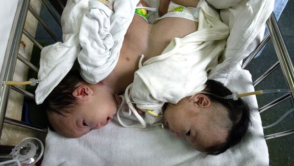 توأمان ملتصقان توأمان ملتصقان - سبوتنيك عربي