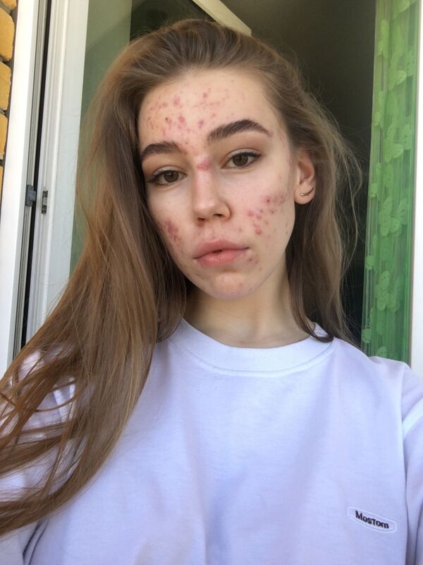 بالصور... كيف تفخر مؤيدات حركة النسوية الإيجابية بعيوب أجسادهن - سبوتنيك عربي