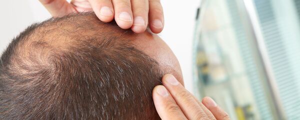 الصلع الصلع - سبوتنيك عربي