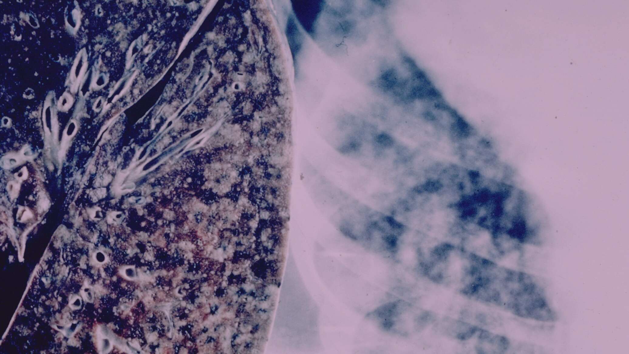 وفاة أكثر من مليون شخص بسبب "المرض المعدي الأشد فتكا في العالم"