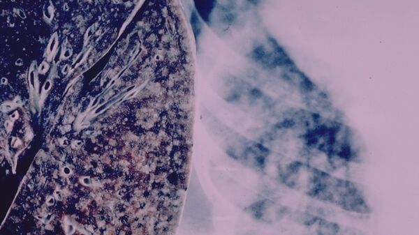 مرض السل - سبوتنيك عربي