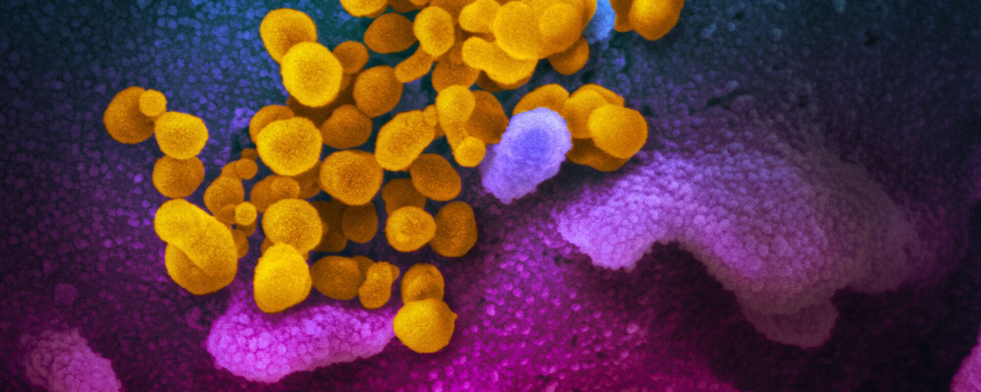 صورة مجهرية إلكترونية لعينة من مريض، لجزيئات فيروس SARS-COV-2 (باللون الأصفر)، والمعروفة أيضًا باسم الفيروس التاجي الجديد كورونا، الفيروس الذي يسبب مرض Covid-19. - سبوتنيك عربي, 1920, 16.04.2021
