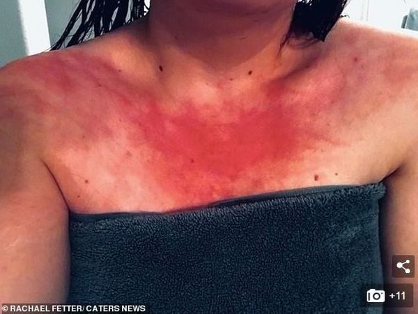 مرض نادر يمنع فتاة من الاستحمام (صور) مرض نادر يمنع فتاة من الاستحمام (صور) - سبوتنيك عربي